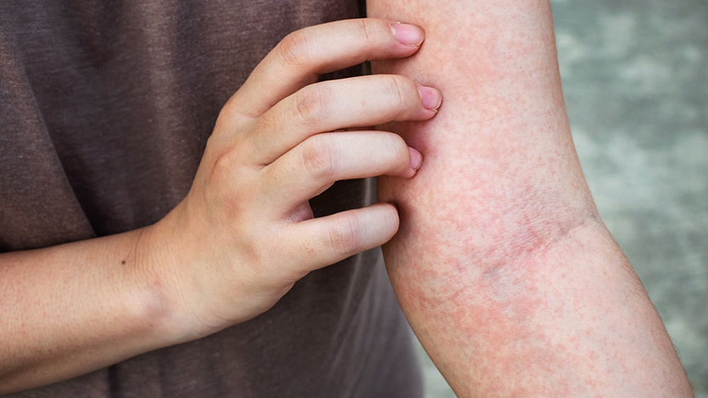 Skin Irritation Protocol