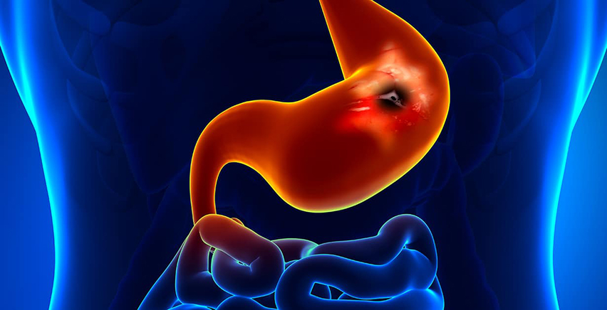 Sharon Broer’s Protocol for Supporting Stomach Lining